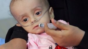 وزير الصحة : أطفال اليمن يعانون معاناة كبيرة جدا وهذا هو السبب