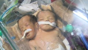 Conjoined Twins Die in Blockaded Sanaa as the UN Watched