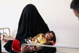 سوء التغذية يفتك بأطفال اليمن