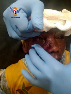 إصابة طفل بإنفجار قنبلة عنقودية من مخلفات العدوان في الجراحي بالحديدة
