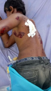إصابة طفلين بانفجار جسم من مخلفات العدوان الأمريكي السعودي الإمارات في مديرية الحالي بالحديدة